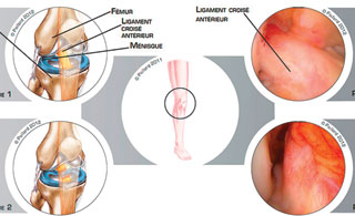 ligamentoplastie du genou